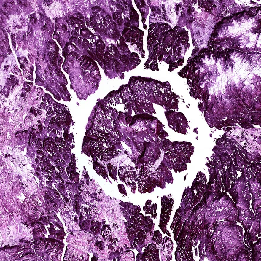 Fibroid Necrosis